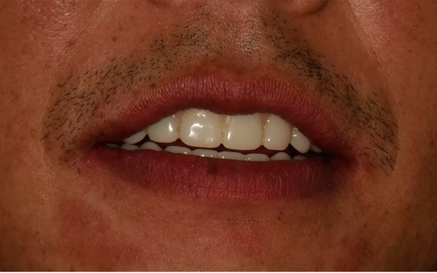 All-on-X Smile, after