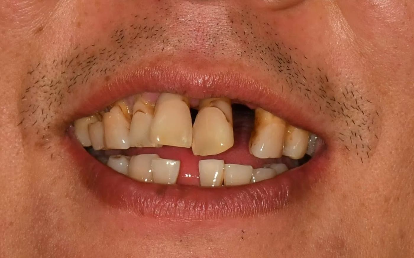 All-on-X Smile, before