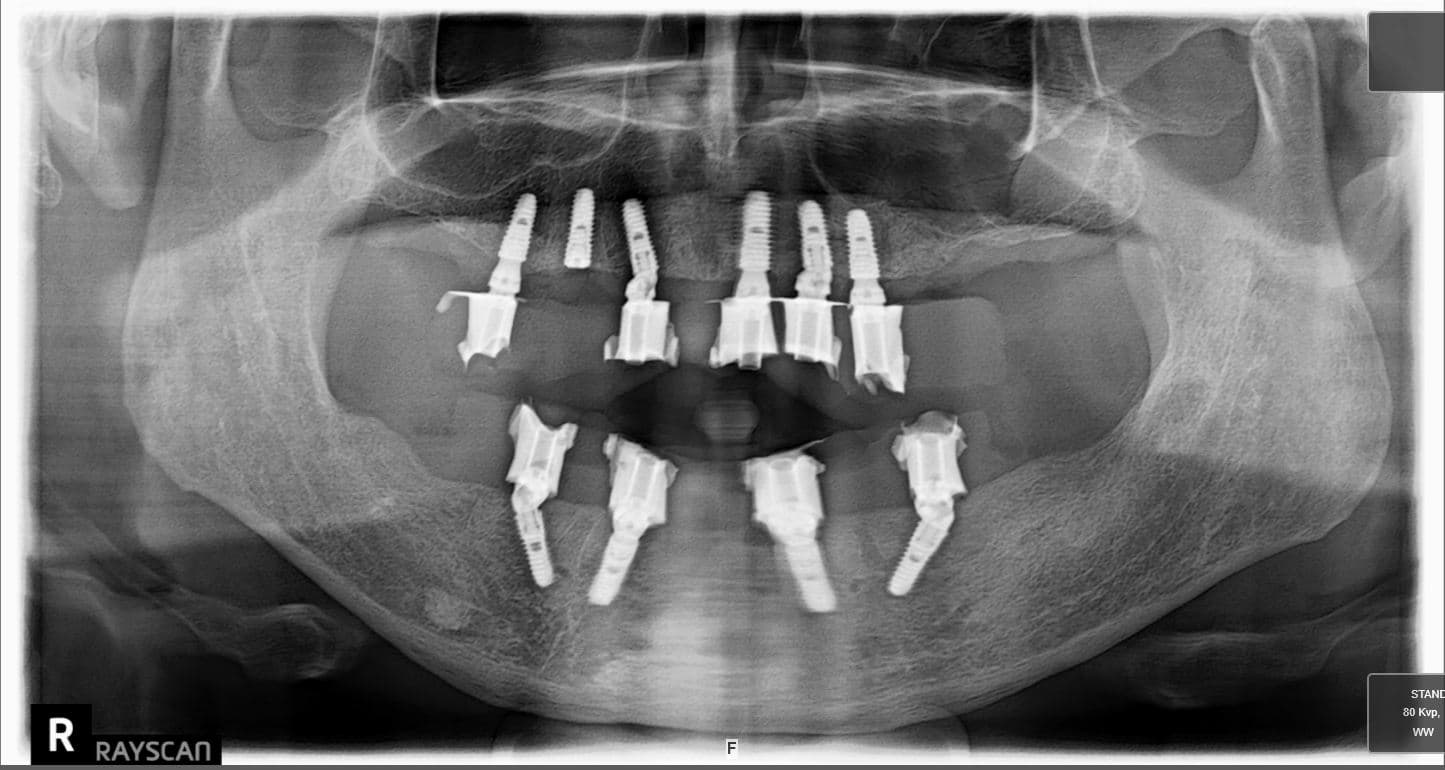 All-on-X Full Arch, after