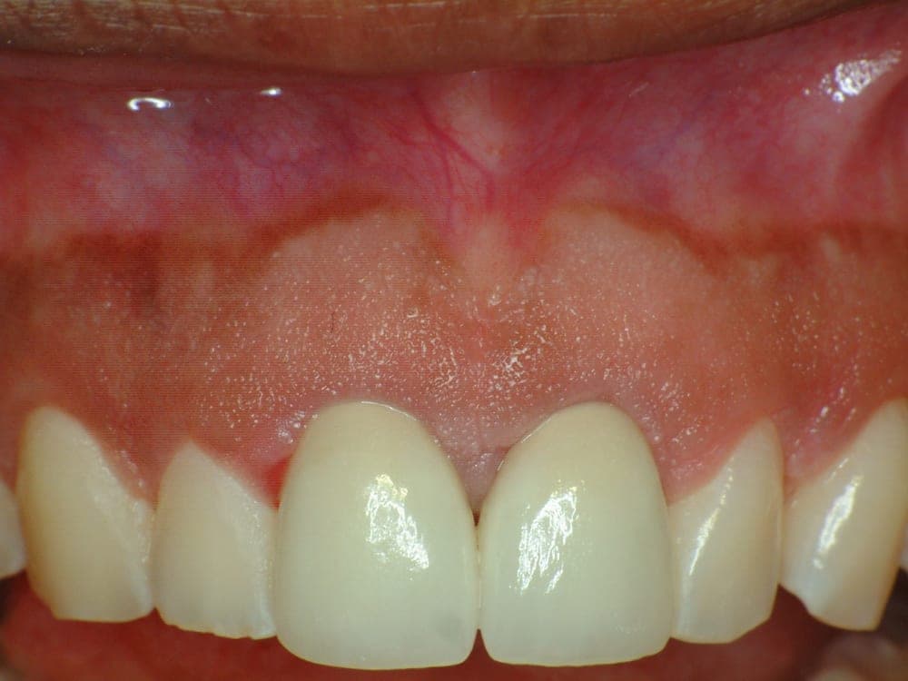 Anterior Restoration, after