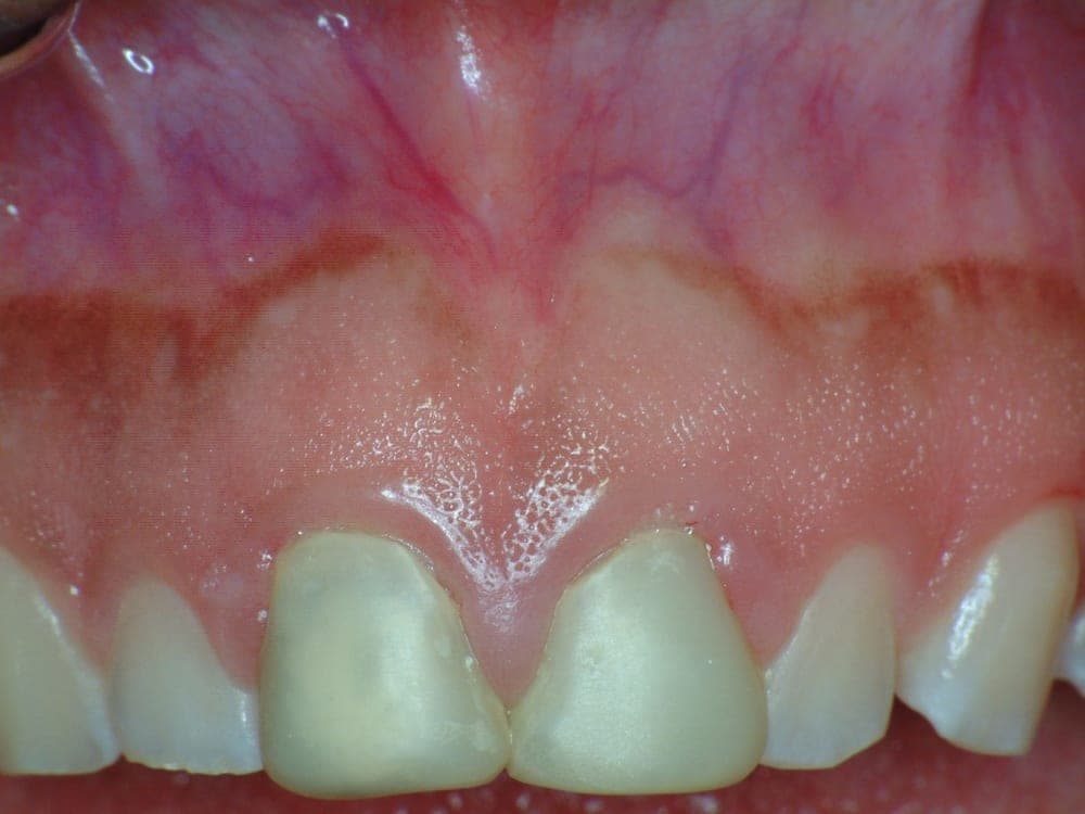 Anterior Restoration, before