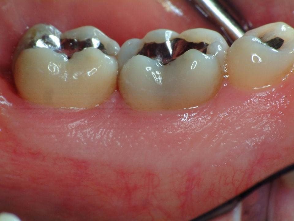 Bone Grafting, after