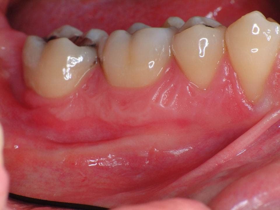 Bone Grafting, before