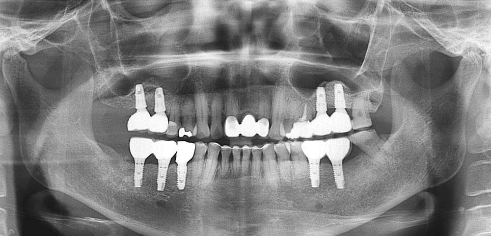Full Mouth Reconstruction, after