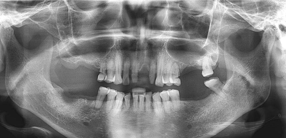 Full Mouth Reconstruction, before