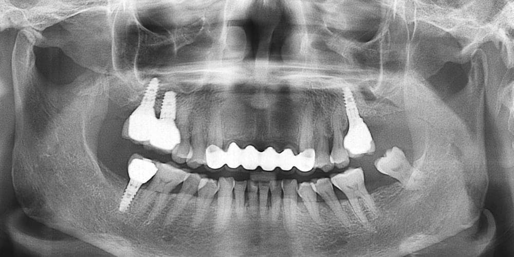 Multiple Implants, after