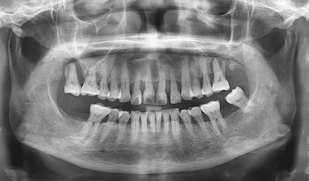Multiple Implants, before
