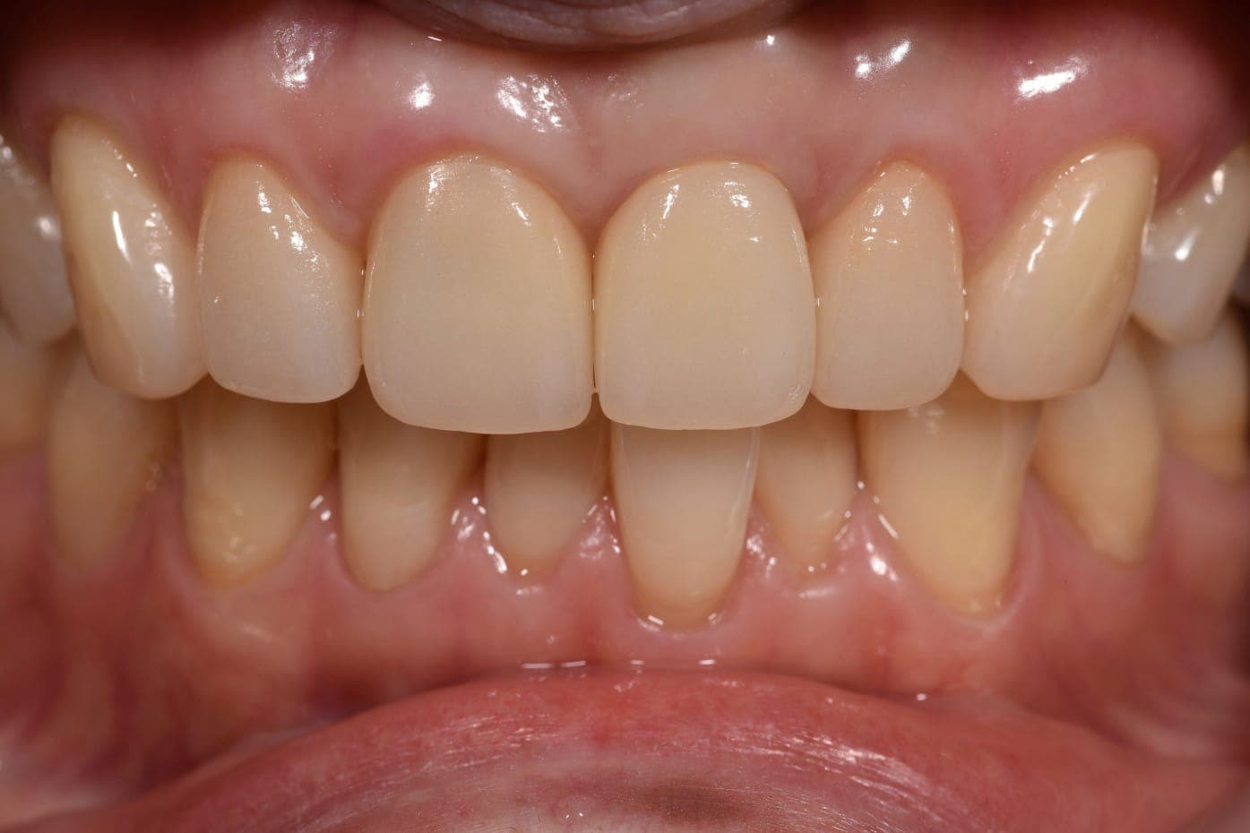 Single Implant at 5 Years, after