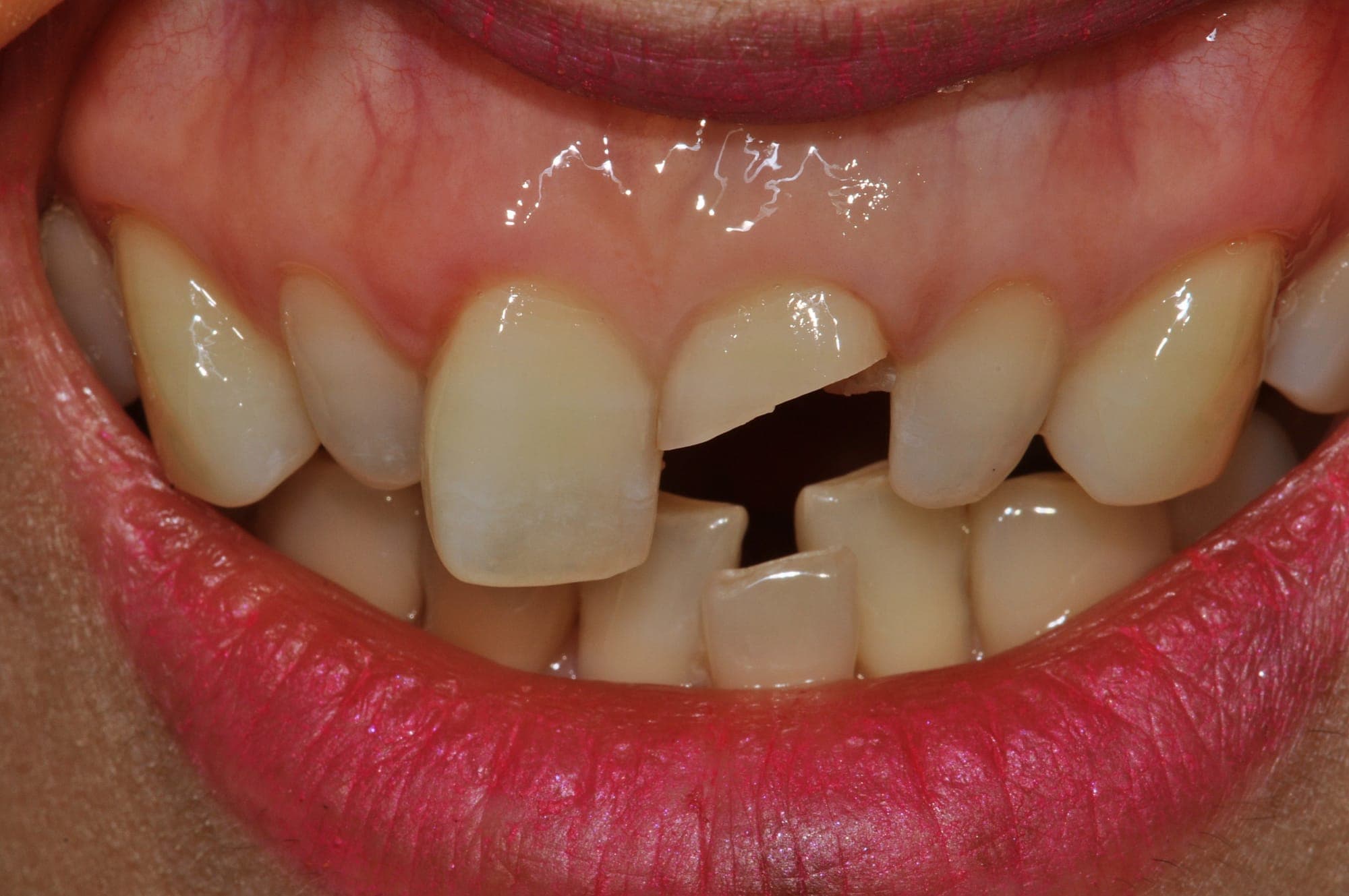 Single Implant at 5 Years, before