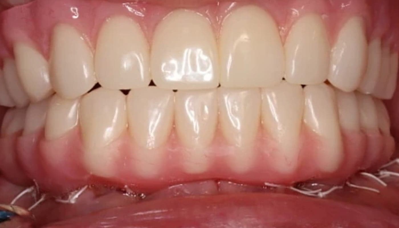 Worn Dentition to Full Arch, after