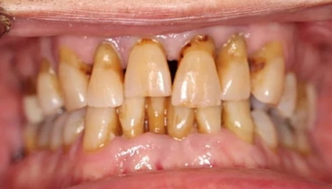 Worn Dentition to Full Arch, before