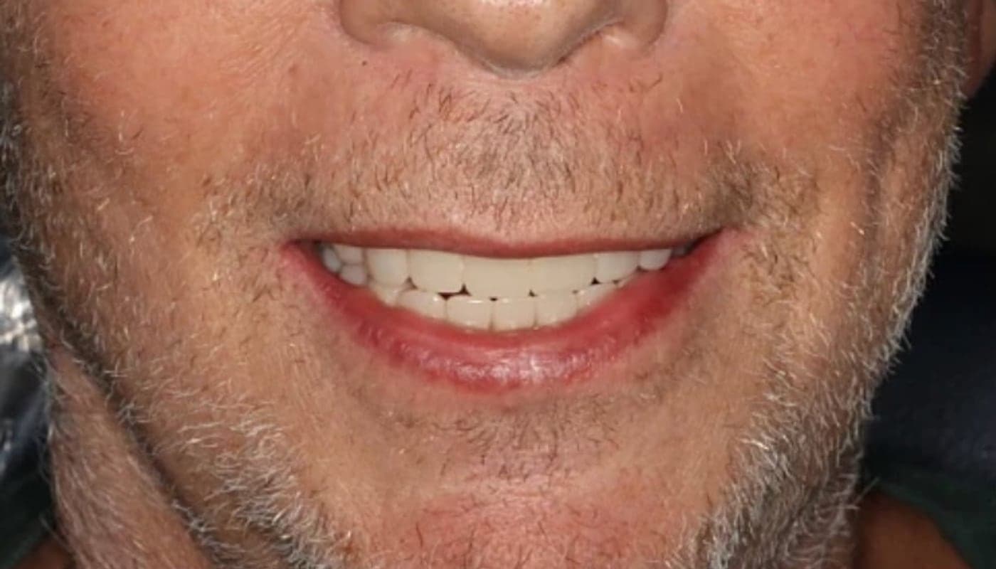 Overdenture Smile, after