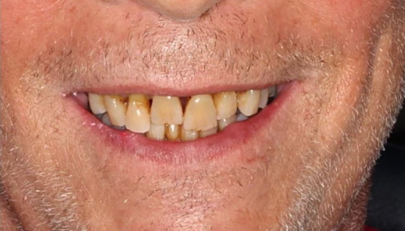 Overdenture Smile, before