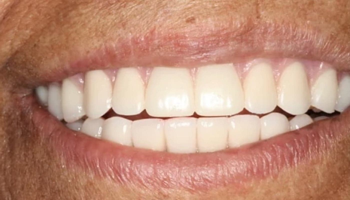 From Locator Abutments to a Finished Smile, after