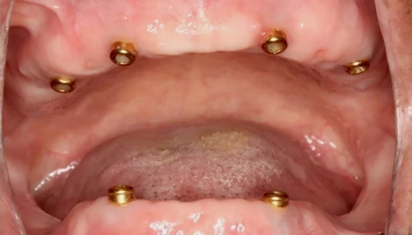 From Locator Abutments to a Finished Smile, before