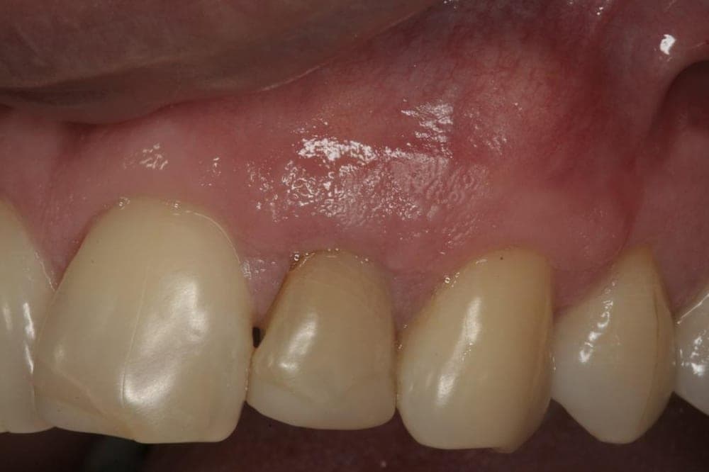 Gingival Grafting, after