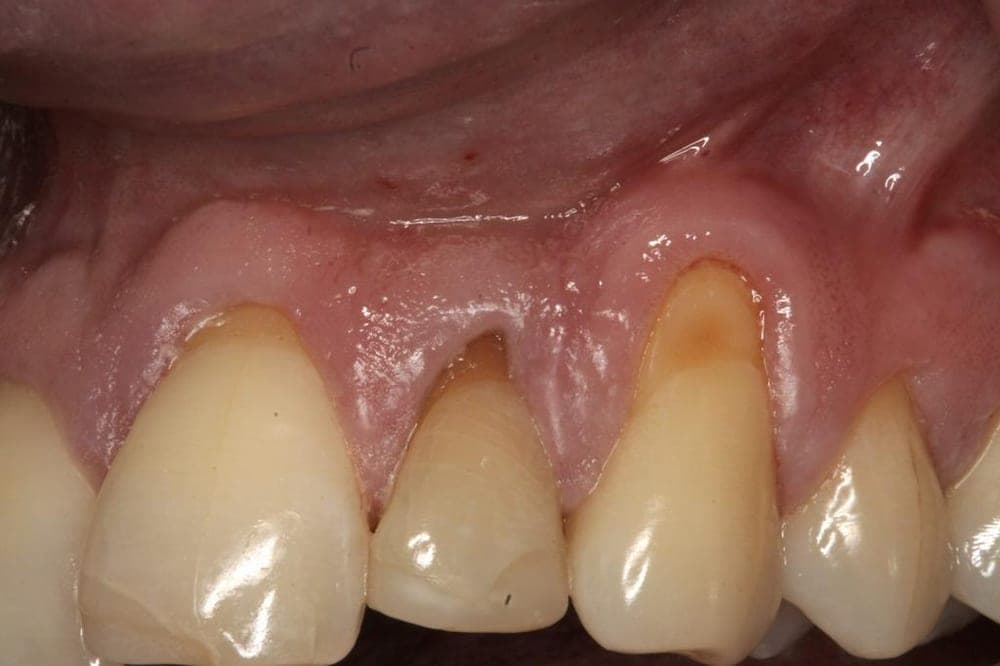 Gingival Grafting, before