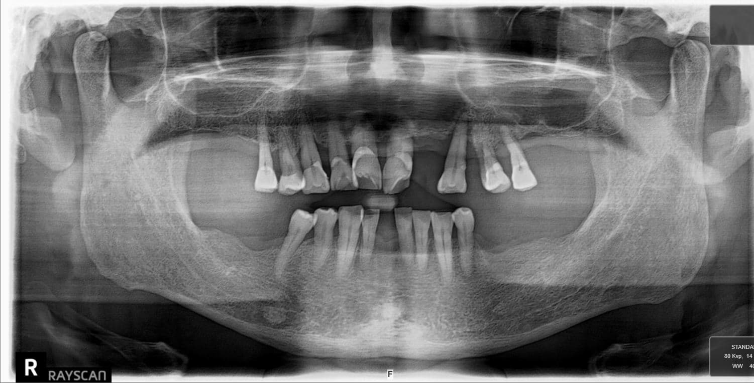 Full-Arch Pano Transformation, before